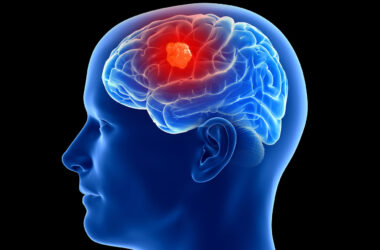 “La ironía es que uno de los virus más mortales del mundo puede ser útil para tratar uno de los cánceres cerebrales más mortales”